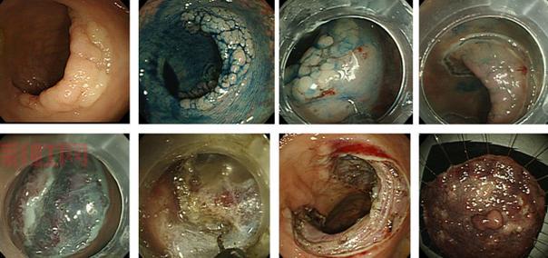 [深入了解ESD手术：内镜下黏膜剥离术的优势与应用]