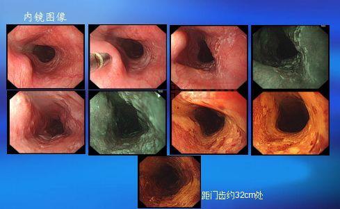 [深入了解ESD手术：内镜下黏膜剥离术的优势与应用]
