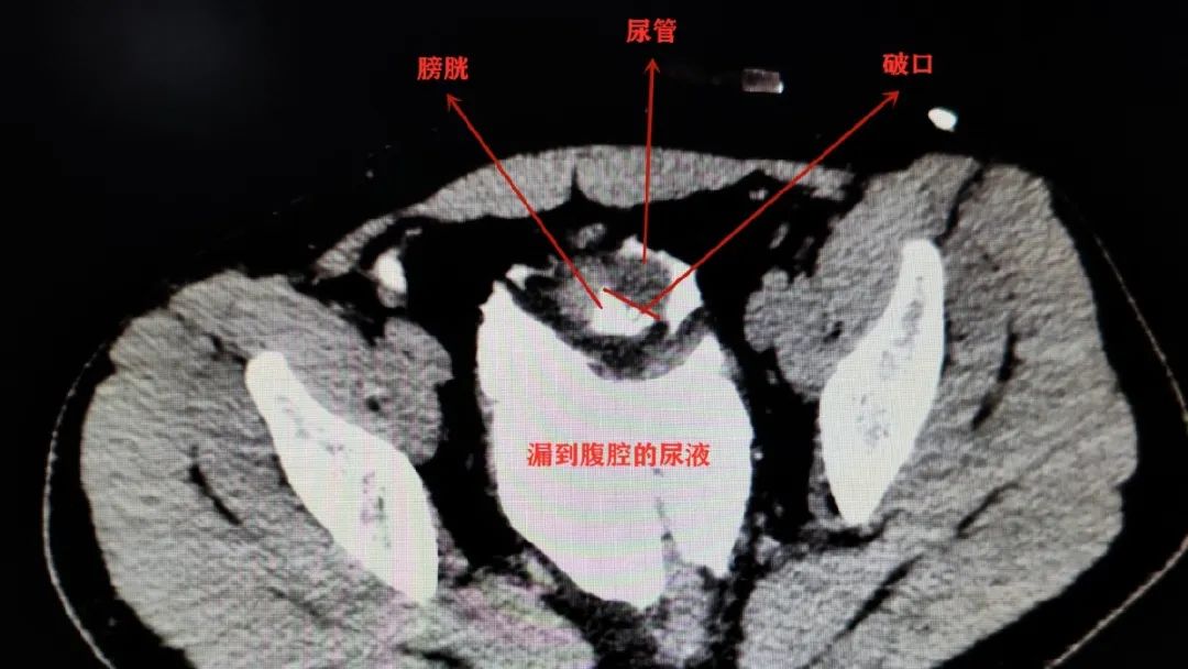 憋尿会憋“死”人?真的!