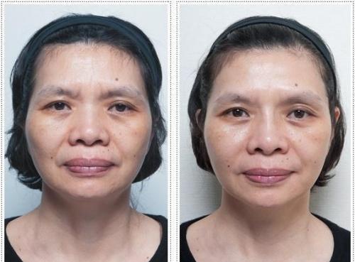 打过“肉毒杆菌”的女人，容貌会有什么变化？庆幸自己知道及时