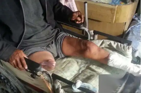 男子因无力支付手术费，自锯双腿，12年后现状如何？