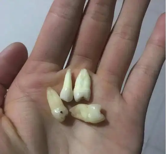 河北男子拿不出100万手术费，回家自己锯掉双腿，12年过去怎样了