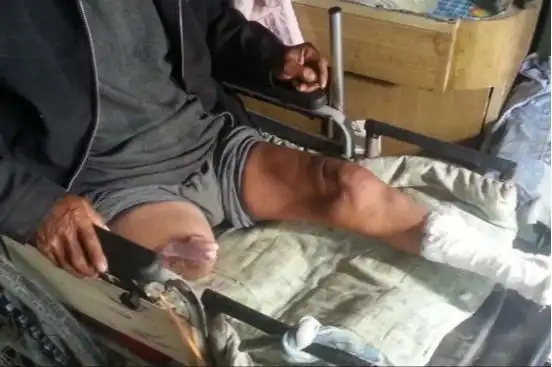 河北男子拿不出100万手术费，回家自己锯掉双腿，12年过去怎样了