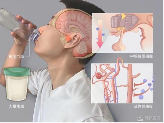 总是口干，喝水也不管用，警惕这些病找上门