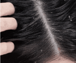 提醒！洗头后这个习惯动作，会加重脱发