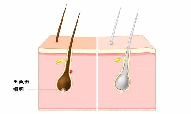 “白头发”可能预示这些疾病!5个因素导致长白发