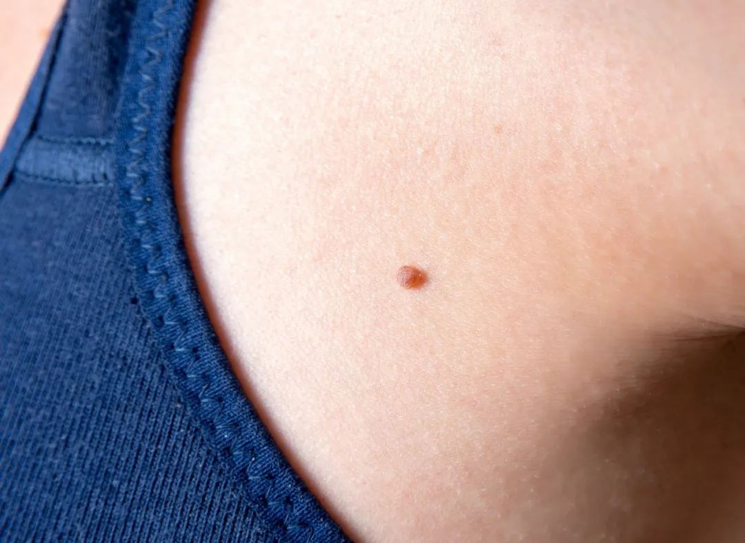 危险的痣长啥样？记住这个“ABCDE法则”！