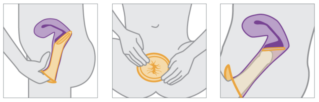 性与生命 | 避孕（十）：安全套，中间一套，无忧无虑吗？（III）