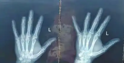 长春一市民打出租车遇意外无名指被夹断 两个月没有拿到任何赔偿