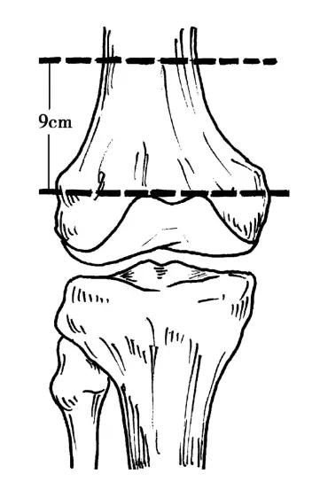 收藏 | 股骨远端骨折4种手术治疗方式