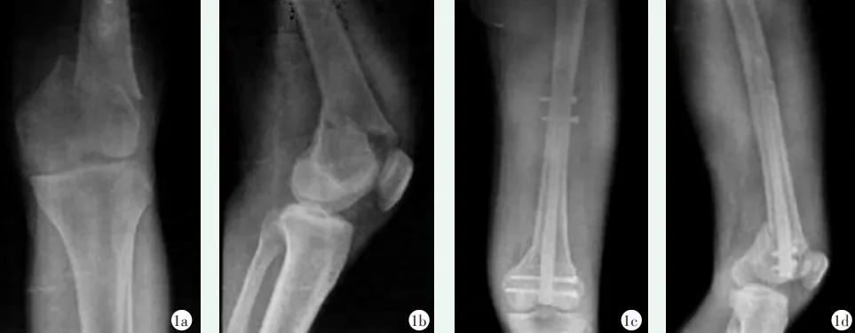 收藏 | 股骨远端骨折4种手术治疗方式