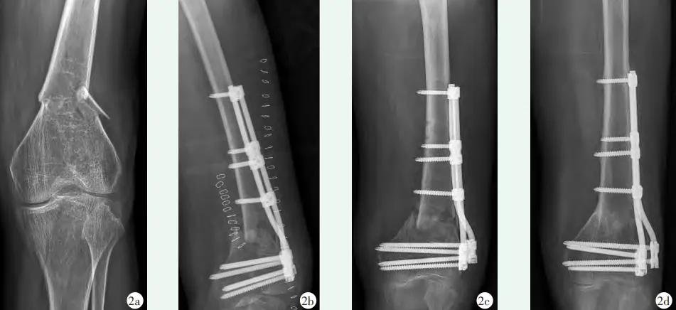 收藏 | 股骨远端骨折4种手术治疗方式