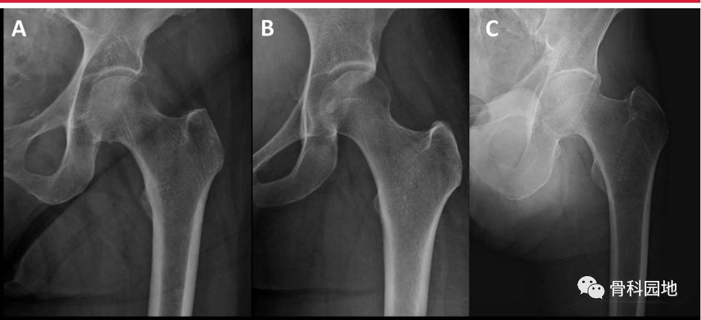 8个方面优化髓内钉治疗固定股骨粗隆间骨折