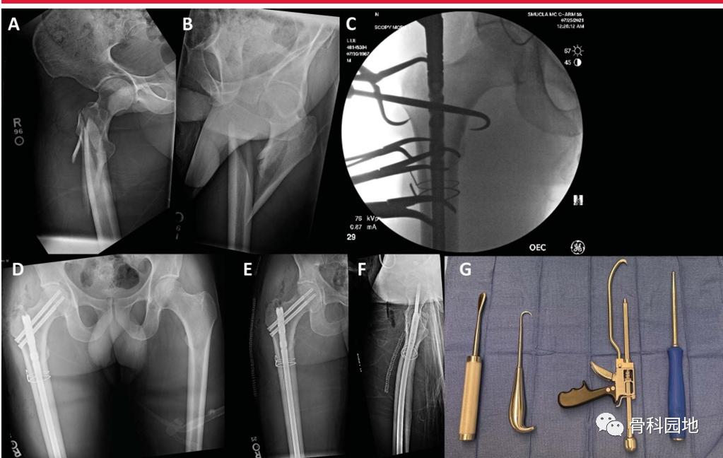 8个方面优化髓内钉治疗固定股骨粗隆间骨折