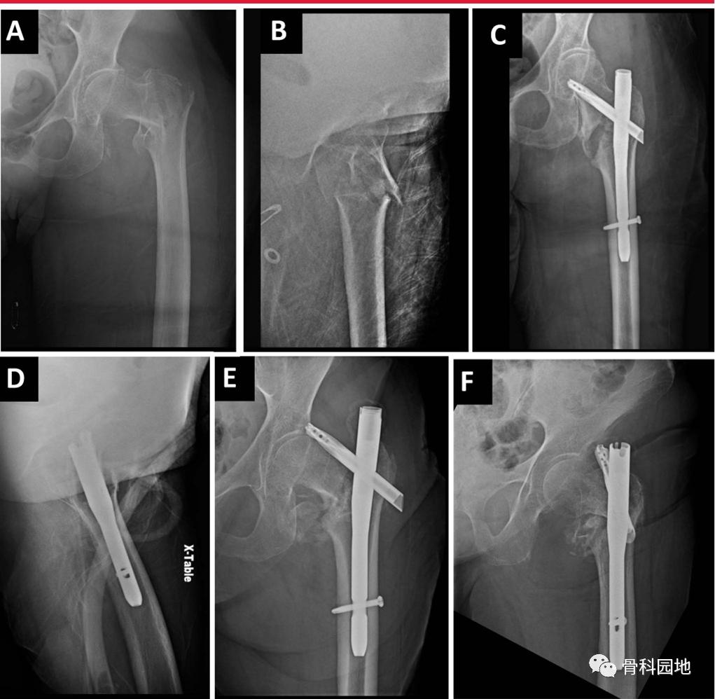 8个方面优化髓内钉治疗固定股骨粗隆间骨折