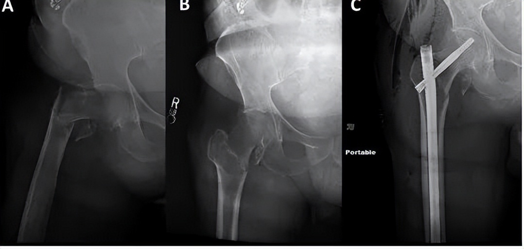8个方面优化髓内钉治疗固定股骨粗隆间骨折