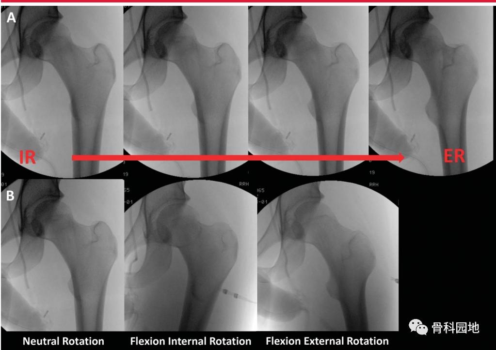 8个方面优化髓内钉治疗固定股骨粗隆间骨折