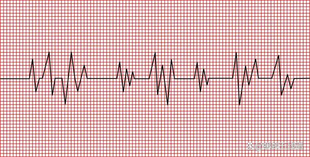 单凭心电图“ST-T段改变”诊断心肌缺血?你又错了……