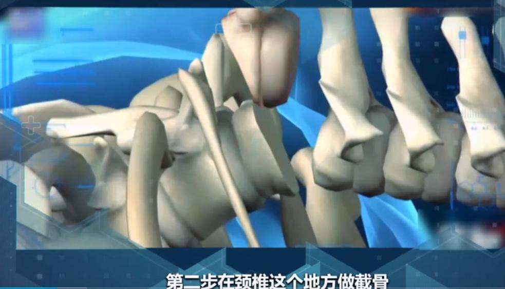 “折叠人”李华：骨头被敲断4次，植入22颗钢钉，如今重获新生