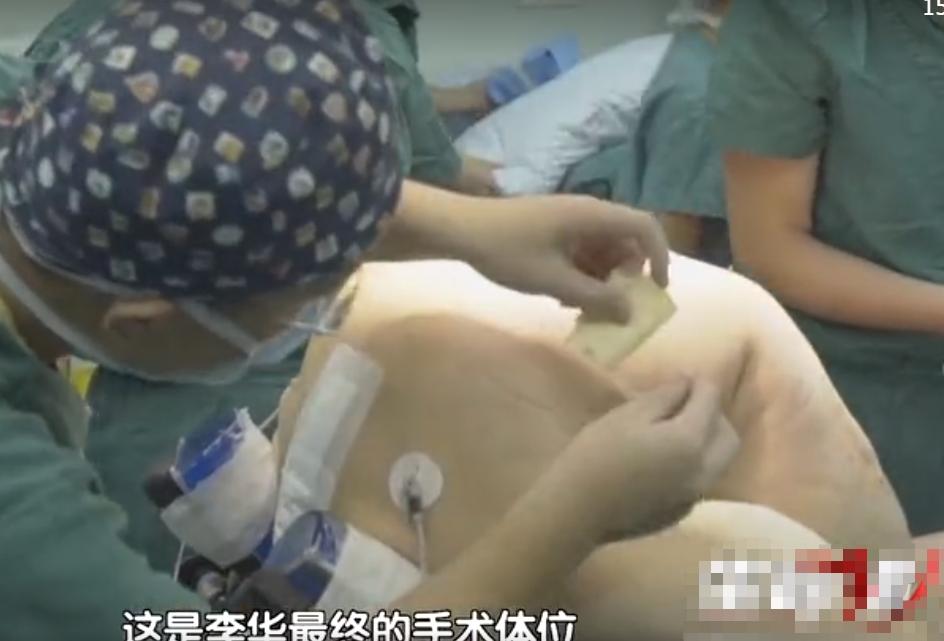 “折叠人”李华：骨头被敲断4次，植入22颗钢钉，如今重获新生