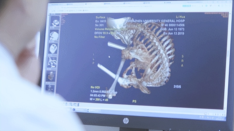 “折叠人”李华：骨头被敲断4次，植入22颗钢钉，如今重获新生