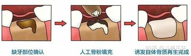 做种植牙一定要植入骨粉吗？什么是植骨？植骨要多少钱？植骨痛不痛？做完植骨多久能恢复？种植牙怎么选择医生？