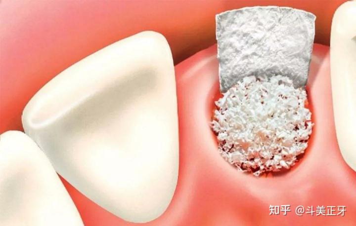 做种植牙一定要植入骨粉吗？什么是植骨？植骨要多少钱？植骨痛不痛？做完植骨多久能恢复？种植牙怎么选择医生？