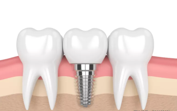 想种牙看这一篇就够了，种植牙全攻略！——种植牙怎么选？怎么种？多少钱？