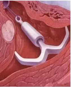 你老婆上环了吗？请善待她的身体，看了想骂人！